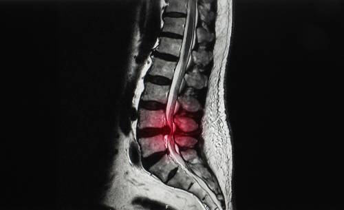 MRI scan of spine showing lower back pain